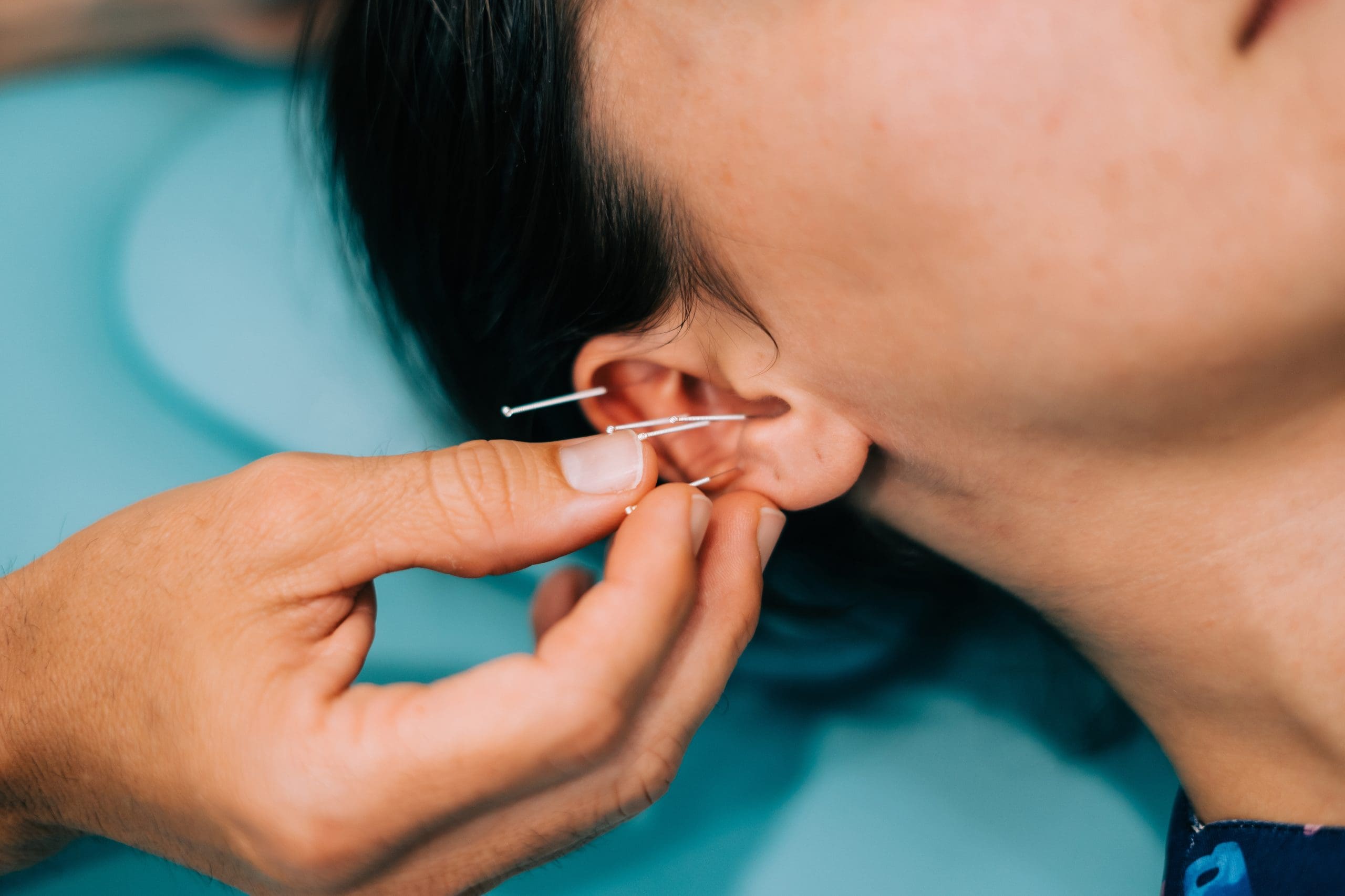Auricular Acupuncture